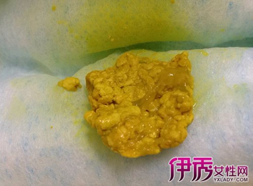 宝宝刚出生时,你会在他的尿布上看到黑绿色,像汽油一样粘粘糊糊的大便