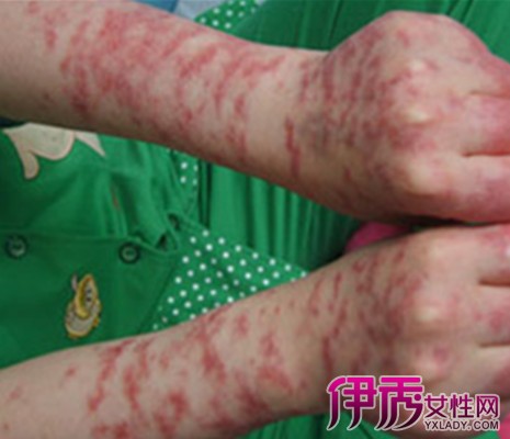 【图】儿童系统性红斑狼疮图片 了解引起红斑狼疮的原因