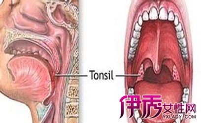 【图】小孩子扁桃体反复发作咳嗽 四个答案解答一切疑问