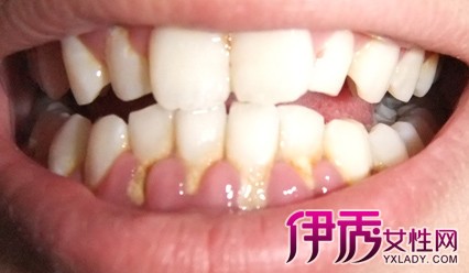 【图】告别牙龈发炎图片 3种治疗牙龈发炎的方法