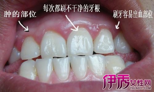 【图】牙龈萎缩图片介绍 几个妙招缓解牙龈问题