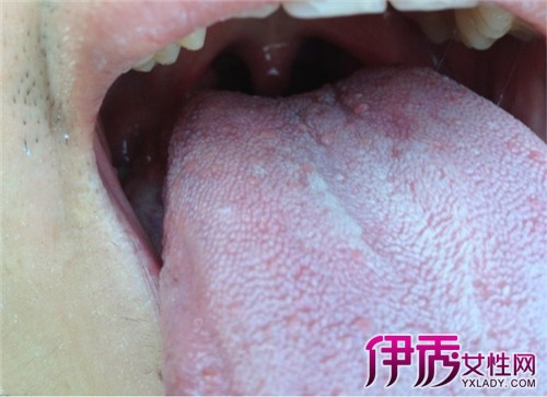 导致舌头上有小红点的原因有很多,那么生活中有哪些原因是最常见的.