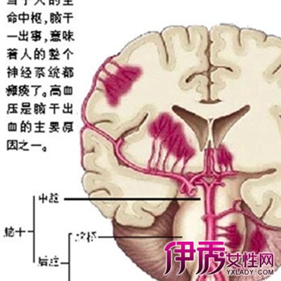 【图】脑干出血多久能度过危险期 脑干素有"生命禁区"