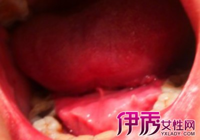 【图】舌头下长肉芽图片详解 了解病源及治愈方法