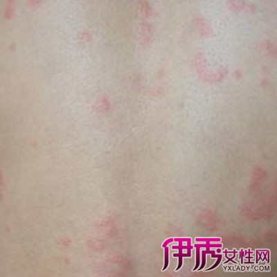 荨麻疹(urticaria)俗称风团,风疹团,风疙瘩,风疹块(与风疹名