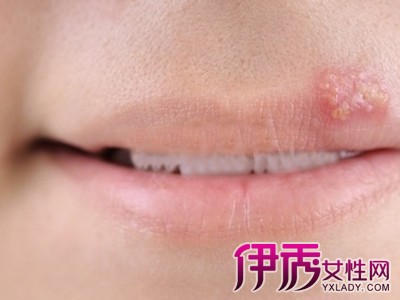 口唇疱疹属于一种病毒性皮肤病,是由于单纯性疱疹病毒感染引起的,中医
