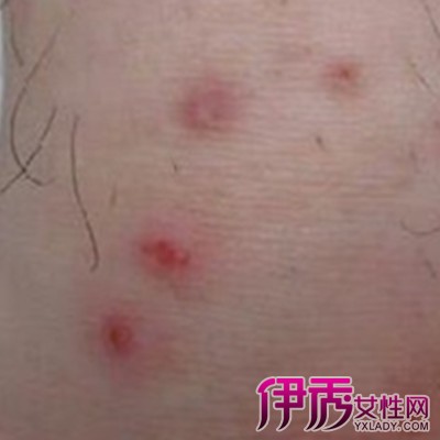硬下疳可以和二期梅毒并存,须与软下疳,生殖器疱疹,固定性药疹等的