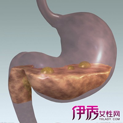 【图】胃窦浅表性胃炎的症状是什么 教你3个食疗方法