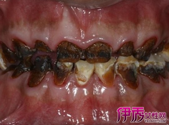 【图】牙齿根部腐蚀图片大全 教你如何保护牙齿健康