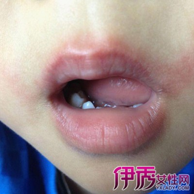 症状体征 口周湿疹的症状有:  1,口唇周围有炎性鳞状皮肤.