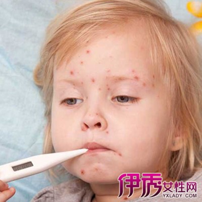 【图】宝宝长水痘初期图片展示 小孩出水痘的