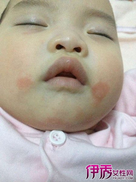【图】宝宝嘴角起红疙瘩警惕是湿疹 4招预防治