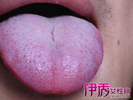 艾滋病早期舌头图片图片