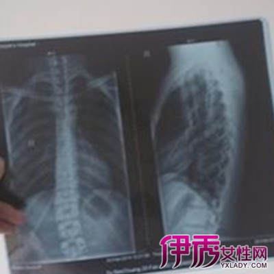 图 你知道胸椎错位的症状有哪些吗 对症治疗有妙招 胸椎错位的症状 伊秀健康网 Yxlady Com