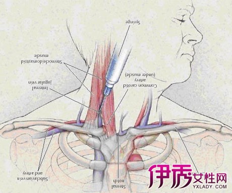 【图】股静脉穿刺置管术 6点详细描述手术要点