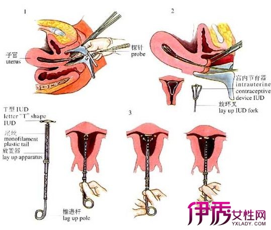 【图】女人带环有几种图片说明 揭秘女性上环