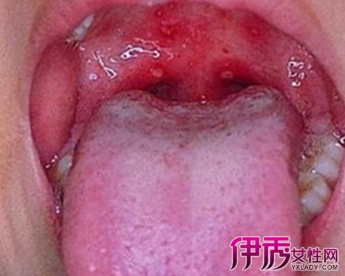 【图】展示舌头白色念珠菌图片 揭秘发病原因及症状