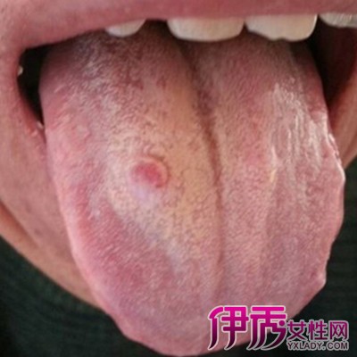 图 舌头出血是什么原因五种治疗方法让你更健康 2 舌头出血是什么原因 伊秀健康网 Yxlady Com