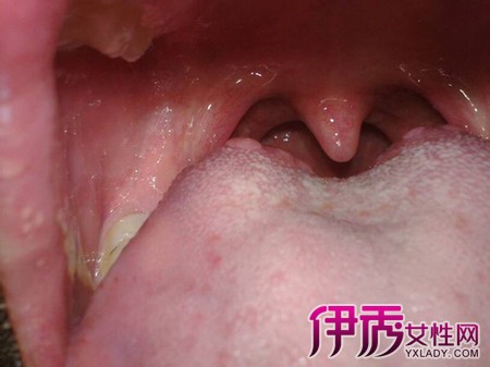 舌头靠近喉咙图片