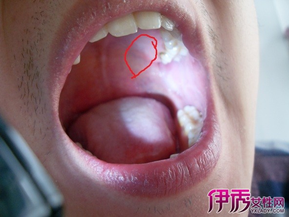 艾滋病舌头小红点图片图片
