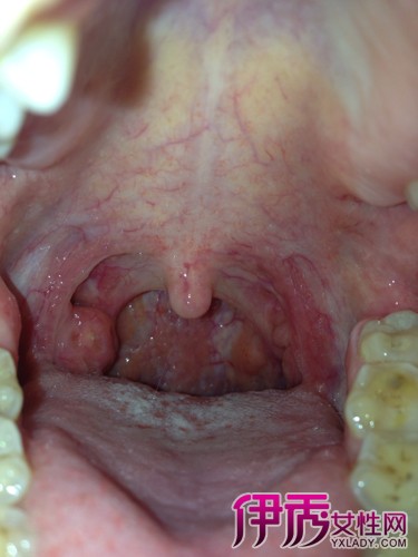 正常喉咙滤泡图片图片