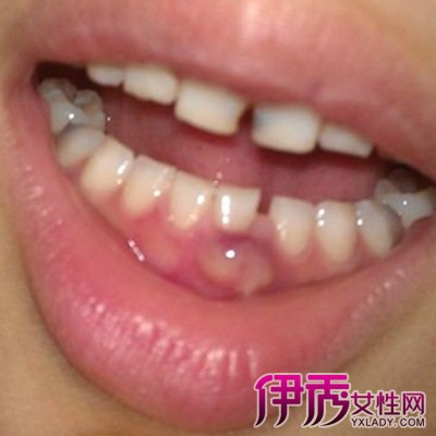 【图】牙龈长脓包可以刺破吗 成年人牙龈脓肿是什么造成