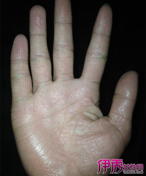 【图】手容易出汗是肾虚吗? 常见症状有哪些?